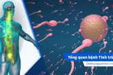 Tổng quan bệnh tinh trùng: Nguyên nhân và Cách điều trị