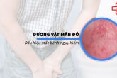 Dương vật nổi mẩn đỏ – Dấu hiệu không thể xem thường