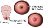 Viêm cổ tử cung cấp độ 2