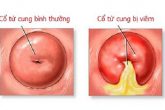 Viêm Cổ Tử Cung