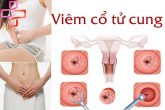 Viêm cổ tử cung: Nguyên nhân, triệu chứng và cách điều trị hiệu quả nhất