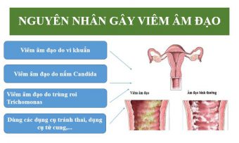 Nguyên Nhân Viêm Âm Đạo