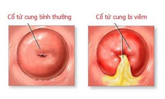 Bệnh Viêm Cổ Tử Cung Và Cách Điều Trị