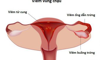 [Bật mí] Chữa viêm vùng chậu hiệu quả chỉ 1 lần duy nhất!