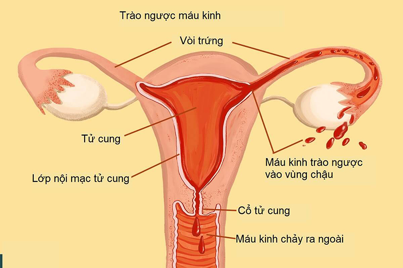 Lạc nội mạc tử cung là gì và những điều cần biết